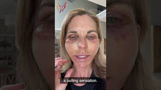 My Advanced Facelift Recovery Day by Day  Real Stories By Real Patients 2022 [upl. by Eisnyl79]