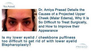 The Causes of Projected Upper Cheeks Malar Edema and How to Improve this Difficult Issue [upl. by Nylessoj]