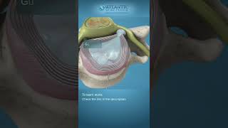 What is Endoscopic Anterior Cervical Discectomy shorts [upl. by Latton]