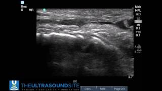 Tibialis Anterior Rupture II [upl. by Rieger]