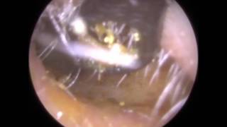 191 BEATING Eardrum visible after simple Ear Wax Removal  Mr Neel Raithatha The Hear Clinic [upl. by Ecitsuj893]