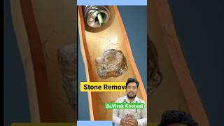 Endoscopic Lithotripsy l Dr Vivek Khetwal shorts stone [upl. by Ardnoek]