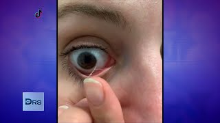 Why Eye Mucus Removal Videos are Popular on TikTok [upl. by Nahem304]