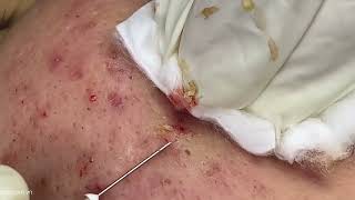 Big Cystic Acne Blackheads Extraction Blackheads amp Milia Whiteheads Removal Pimple Popping [upl. by Darla]