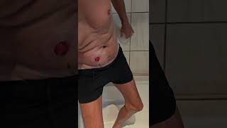 Ileostomy  Part 3 [upl. by Longfellow]