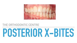 Posterior CrossBite Correction at The Orthodontic Centre [upl. by Katt]