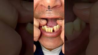 Acrylic partial dental prosthesis the most economical mrdent dental dentalclinic smile [upl. by Jorin64]