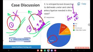 True Broad Ligament Fibroid case discussion EndoGyneTraining Quiz 13 [upl. by Egbert]