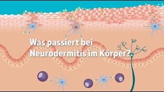 Was passiert bei Neurodermitis im Körper [upl. by Koch32]