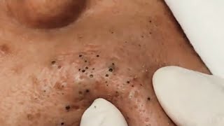 Satisfying Blackhead Removal [upl. by Hnil]