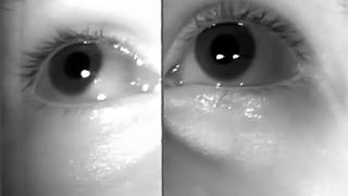 WallEyed Bilateral Internuclear Ophthalmoplegia WEBINOMoran226 [upl. by Patricia]