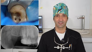 Root Canal Treatment Of The Maxillary Second Molar Tooth  Root Canal Treatment [upl. by Demahom931]