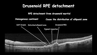 Clinical changes in RPE course  Drusen [upl. by Semele657]