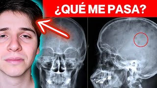 MIELOMA MÚLTIPLE ► FISIOPATOLOGÍA y SÍNTOMAS  EXPLICACIÓN MAESTRA en 8 MINUTOS MÍRALO 😲😲😲😲😲😲😲 [upl. by Lalad]