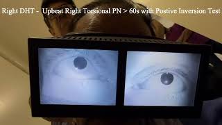 Right Posterior Semicircular Cupulolithiasis with Positive Inversion Test [upl. by Audrie]