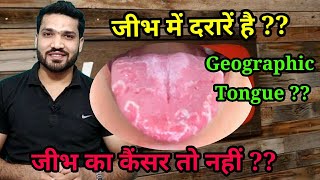 जीभ में दरारें धब्बे क्यों है  कैन्सर  Geographic tongue Causes symptoms amp Treatment [upl. by Can310]