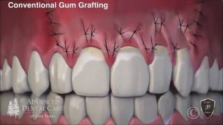 Correcting Receding Gums through Pinhole Surgery [upl. by Laktasic]