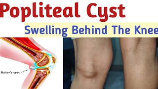 Popliteal cyst in the knee Swelling behind the knee knee pain bakers cyst Bakers cyst treatment [upl. by Leifer]