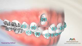 Orthodontic Treatment for Impacted Canine  Laser Exposure [upl. by Ecnaiva322]