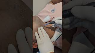 wart removal by Electrocautery machine [upl. by Alis]