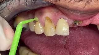 Houston Cosmetic DentistStep by Step removal of gum line decayInvisible restorations [upl. by Dviad]