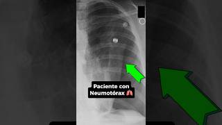 Cuál es el mejor modo ventilatorio para paciente con Neumotórax ⁉️🫁 emergency [upl. by Yot]