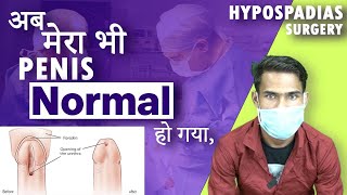 Successful Hypospadias Surgeon in Kolkata  मूत्र का छिद्र सही जगह पर न खुलने की समस्या  Dr Nagwani [upl. by Anam]