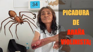 Sra Violeta Chiñas  Paciente con Picadura de Araña Violinista en Cuautla Morelos [upl. by Aleedis]