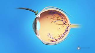 Vitrectomy Surgery for Macular Holes [upl. by Gurias54]