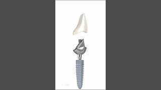 Ceramic Crown amp Implant Abutment Anatomy [upl. by Ydnes]