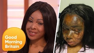 Recovering From an Acid Attack  5 Years on  Good Morning Britain [upl. by Perloff434]