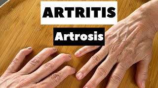 ARTRITIS VS ARTROSIS DE MANOS [upl. by Hsuk]