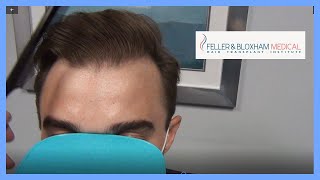 Diffuse Hair Loss  Hair Transplant Results  Feller amp Bloxham Medical  NY NYC Philadelphia [upl. by Ayatnahs701]