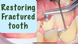 Tooth Fracture Restoration with composite amp fiber post [upl. by Ecargyram]