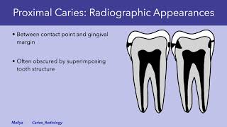 Radiologic Detection and Evaluation of Caries [upl. by Lombardi]