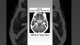 Subarachnoid Hemorrhage CT Scan viral youtubeshorts ct shortsfeed [upl. by Giffie]