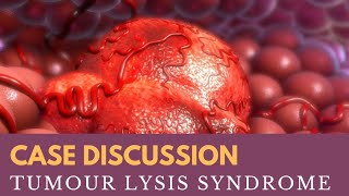 Case Discussion  Tumour Lysis Syndrome [upl. by Eecram]