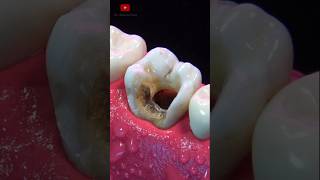 ASOMBROSA restauración dental asmr [upl. by Aydin]