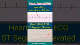 ECG changes During Heart Attack medicine ecg [upl. by Laoj557]