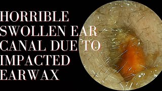 HORRIBLE Swollen Ear Canal Due To Impacted Earwax [upl. by Owades824]