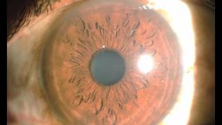 PEARL PrEsbyopic Allogenic Refractive Lenticule  A new Presbyopic Corneal Inlay [upl. by Naoma797]