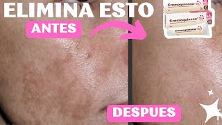 Como Desmanchar la Piel con Cremoquinona Día Experiencia y Resultados Reales Post Acne✅ [upl. by Nalid]