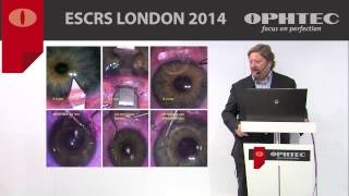 Zero astigmatism outcomes in Phakic IOL implantation by Prof M Pozharitsky Russia [upl. by Eenhat40]