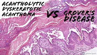 Acantholytic Dyskeratotic Acanthoma vs Grovers Disease 5Minute Pathology Pearls [upl. by Aivlys]