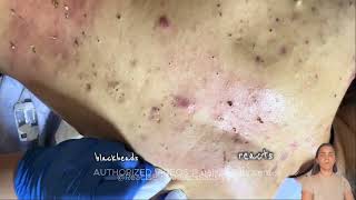 blackhead removal blackheads removal blackhead blackheads blackheads lips blackheads around lip [upl. by Lokim]