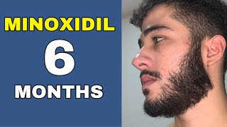 Minoxidil Beard Journey 6 MONTHS TRANSFORMATION [upl. by Assenab558]