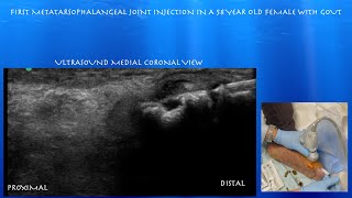 Ultrasound Guided First Metatarsophalangeal Joint Injection by probeultrasound [upl. by Delanie]