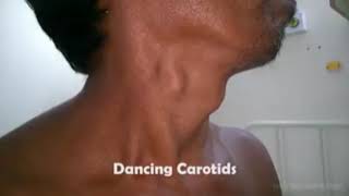 Dancing carotid aortic regurgitation 👇 read description [upl. by Carrnan]