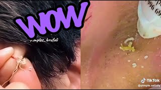 Top Satisfying Pimple Pops of 2024 Blackheads Cysts and More [upl. by Maeve]