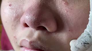 ACNE NOSE  Acne Treatment Mai Ngọc [upl. by Eecats]